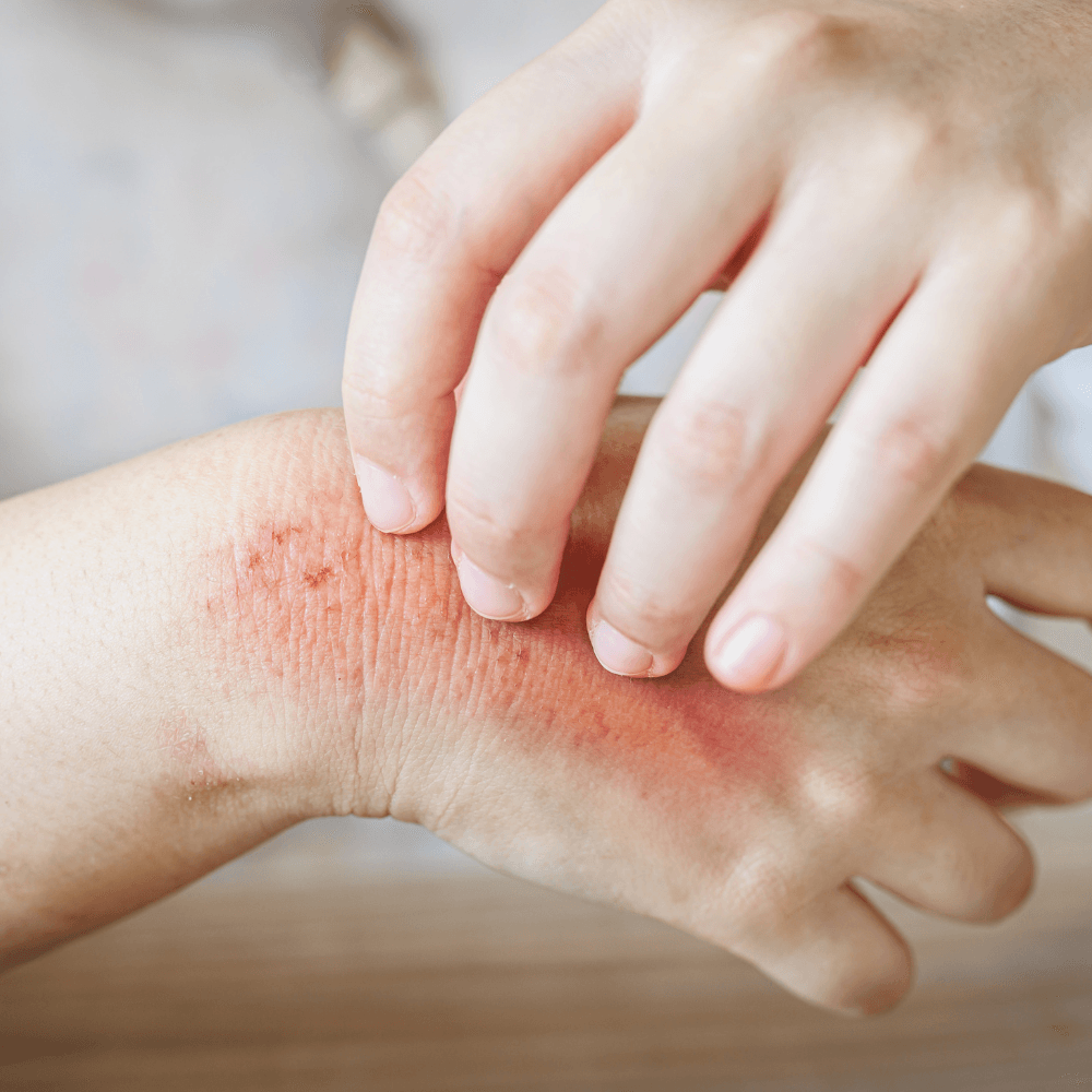 Soin réparateur en chantilly pour eczéma et psoriasis