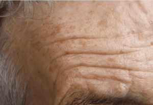 Zoom sur des tache localisé sur le front