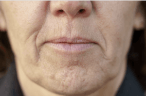 Localisation du sinus maxillaire dans le visage