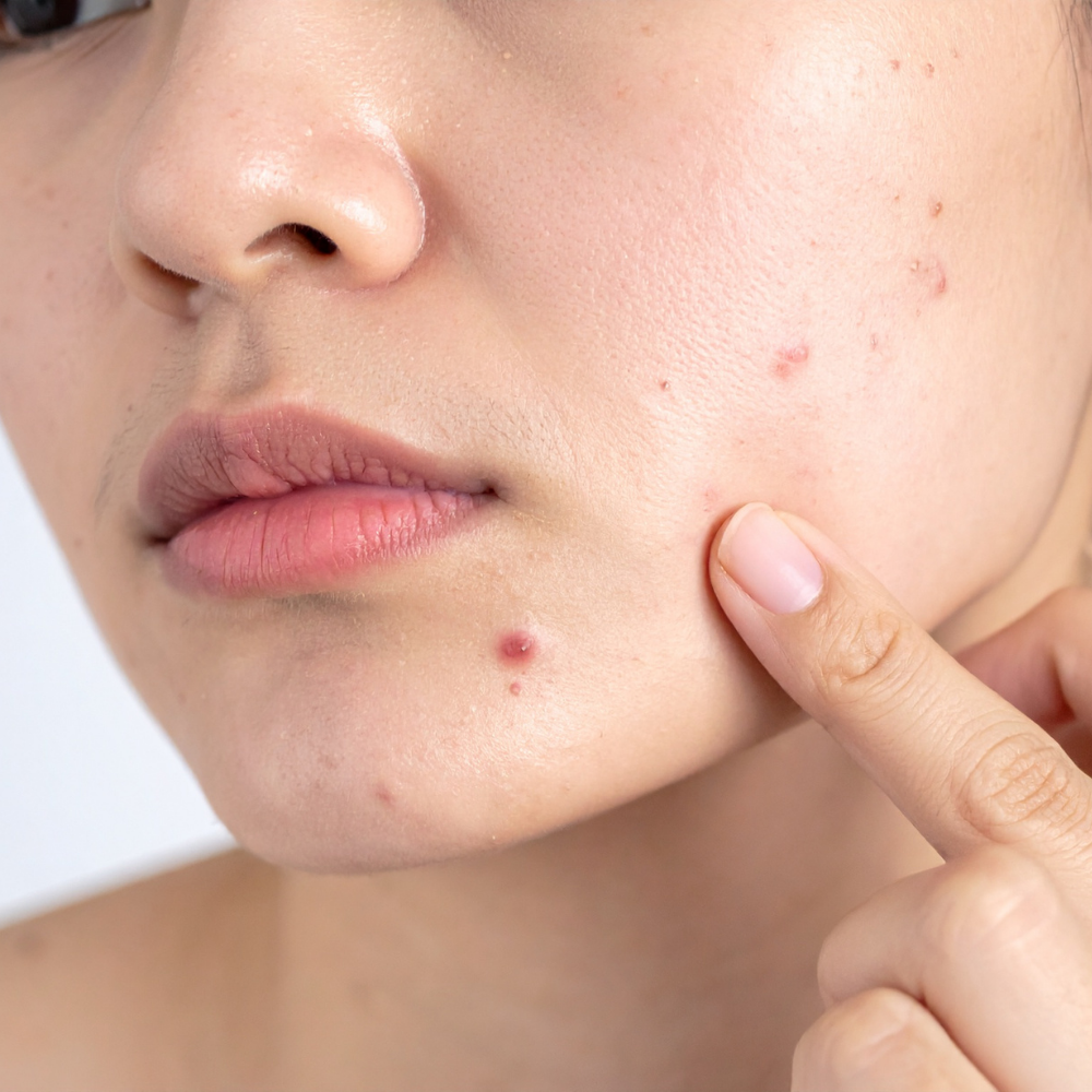 Impact du soleil sur les peaux sujettes à l’acné